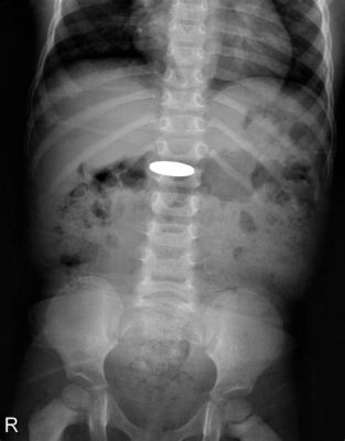 Can X-Ray Detect Plastic in Stomach: A Journey Through the Labyrinth of Medical Imaging and Beyond