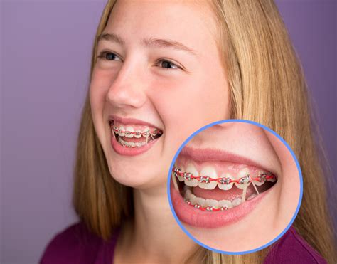 What Does Triangle Rubber Bands Braces Do and Why Do They Make My Teeth Feel Like They're Throwing a Party?